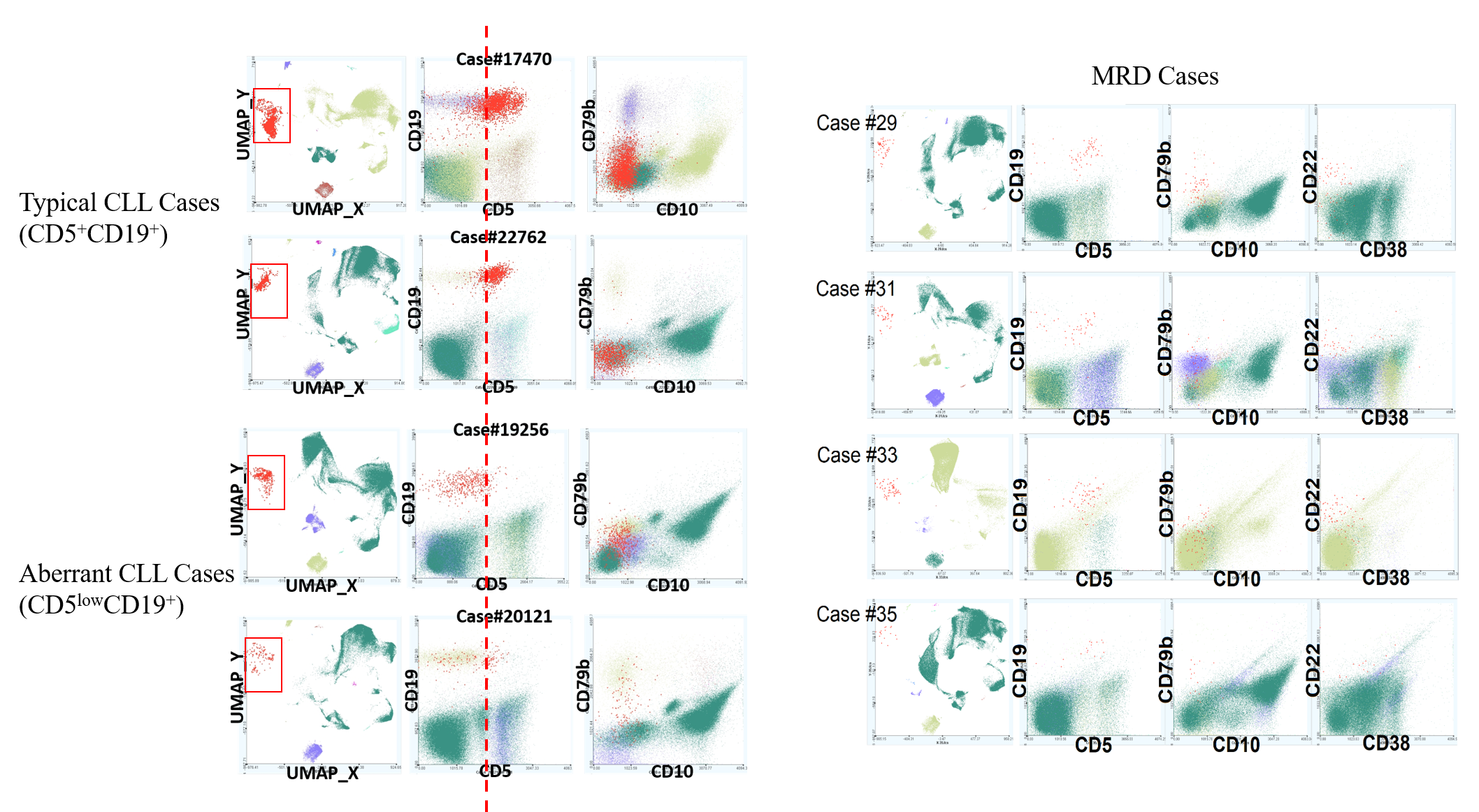 Non-linear embedding transformation (UMAP) of preexisting clinical flow cytometry data clearly identifies typical and atypical CLL, as well as minimum residue disease (MRD) cases.